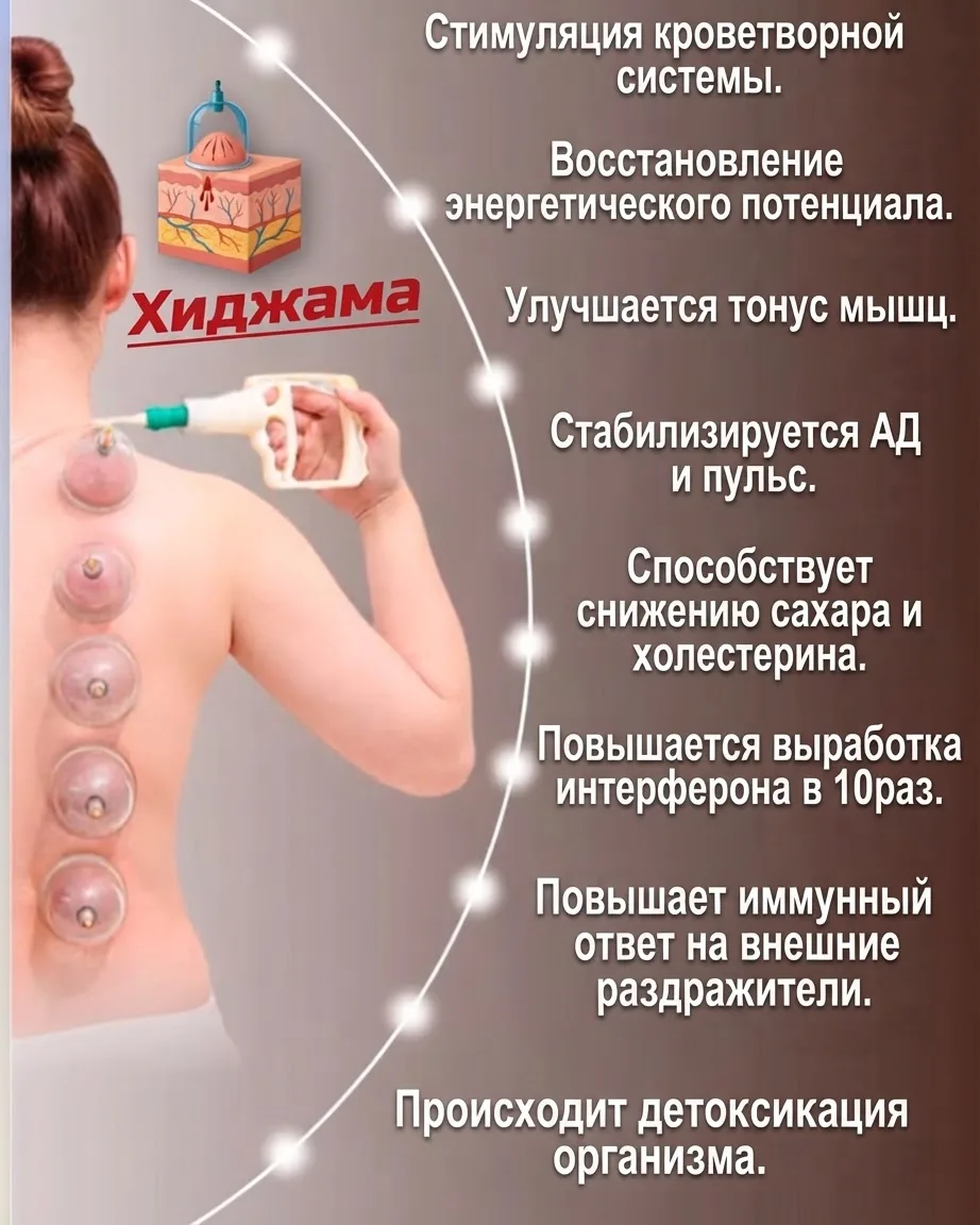 Хиджама при болях в спине — Алматы | от 10 000 тг за сеанс